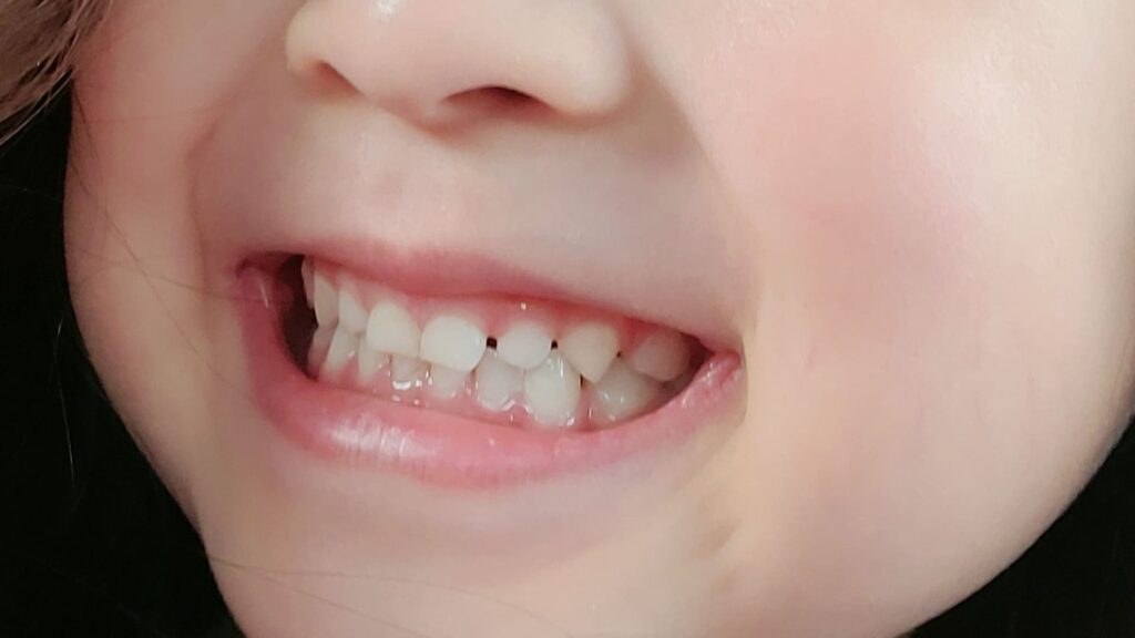 子供の歯並び